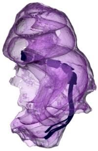 Schematische Darstellung eines Cochlea-Implantats im Ohr