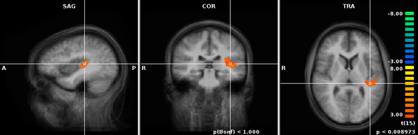 3 MRT-Bilder, die die Hörverarbeitung im Gehirn zeigen
