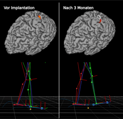 Vergleich von Bewegungsabläufen vor und nach einer Operation im Gehirn 